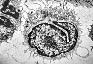 M,66y. | blood - hairy cell leukemia